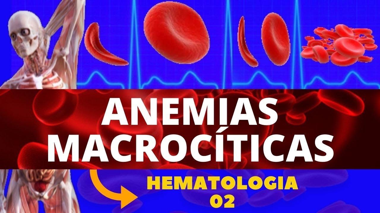 ANEMIAS MACROCÍTICAS | ANEMIA MEGALOBLÁSTICA E ANEMIA PERNICIOSA - HEMATOLOGIA