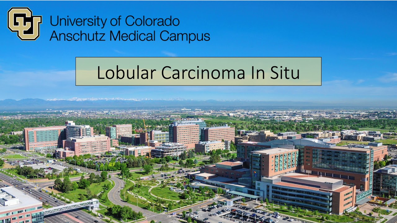 Lobular Carcinoma In Situ and High Risk Breast Lesions