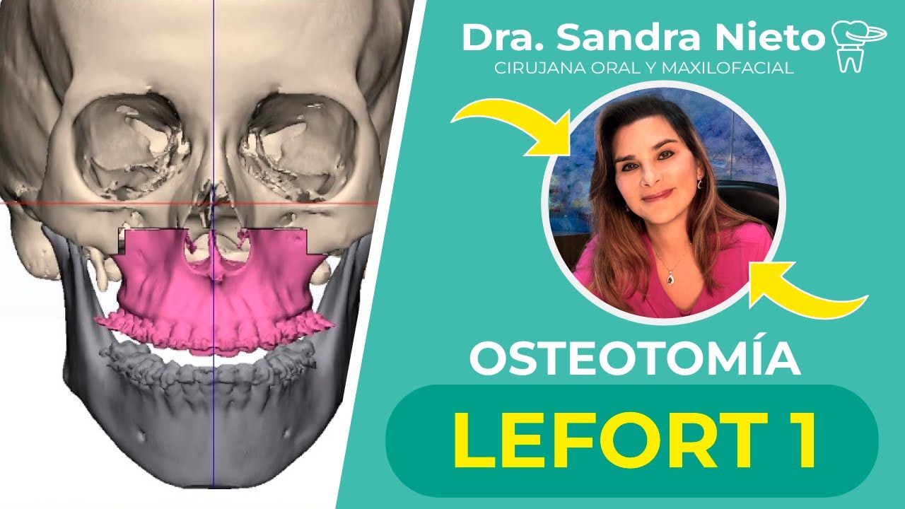 OSTEOTOMÍA LEFORT TIPO 1