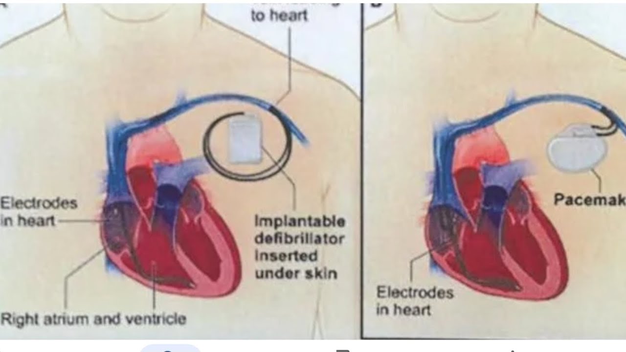 Pacemakers and Defibrillators CPT coding guidelines in Cardiovascular system.