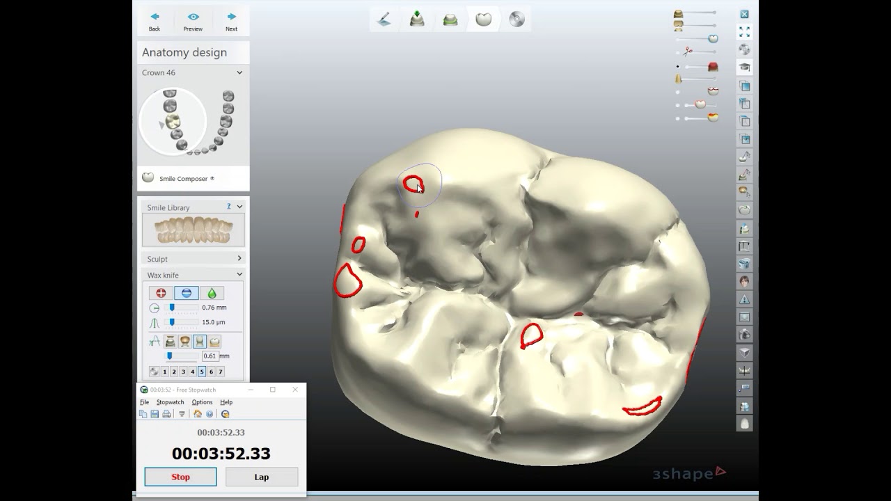 Fast 5 Minute Crown Design with 3Shape