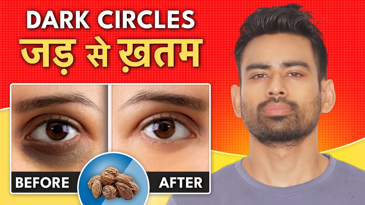 Dark Circles को Permanently हटाएँ  (Best Ayurvedic Home Remedy) | Fit Tuber Hindi
