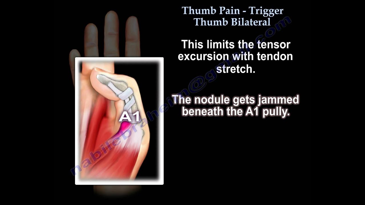 Thumb Pain , Trigger Thumb , Bilateral - Everything You Need To Know - Dr. Nabil Ebraheim