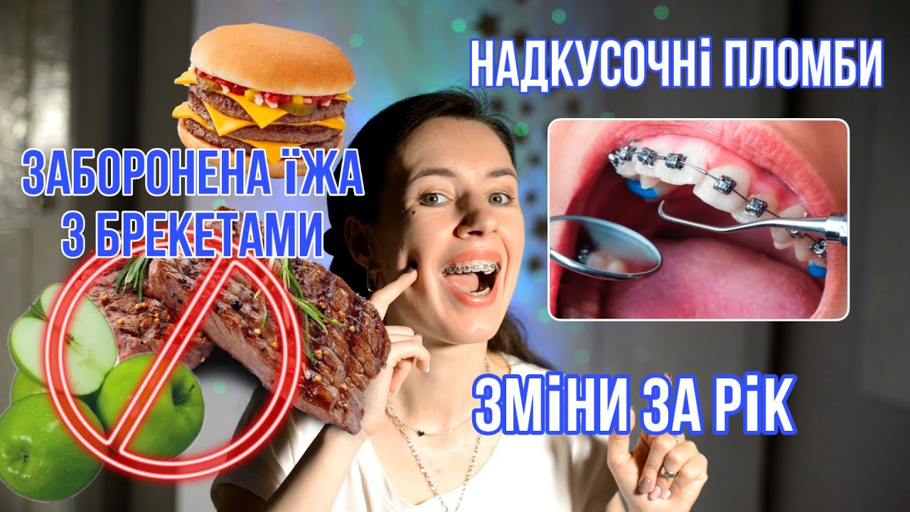 що НЕ МОЖНА ЇСТИ з брекетами? НАДКУСОЧНІ ПЛОМБИ | Зміни через 1 рік || KrissTinn