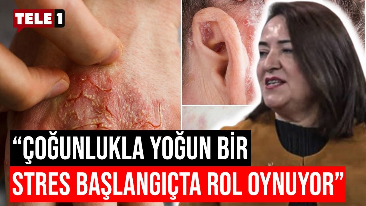 Sedef hastalığının belirtileri ve tedavi seçenekleri nelerdir? | SAĞLIK GÜNDEMİ (16 ARALIK 2023)