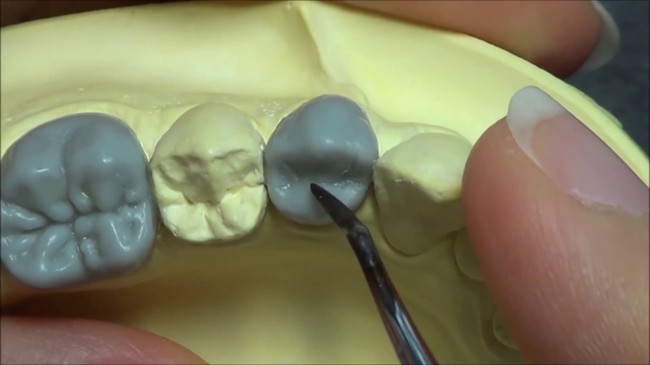 Live wax up - Lower 1st premolar (occlusion)