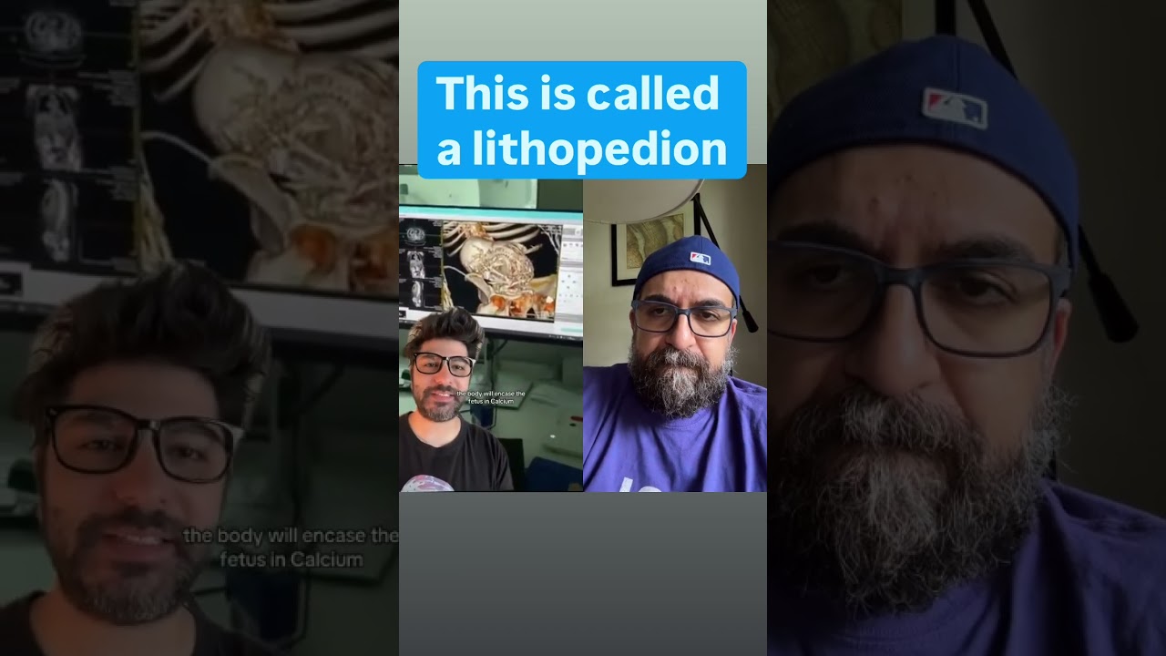 Lithopedion - A Rare Complication of pregnancy