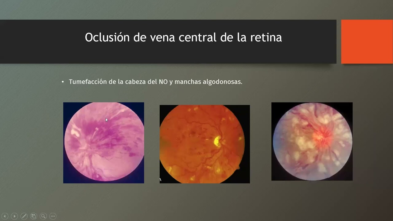 Oclusiones Venosas de La Retina