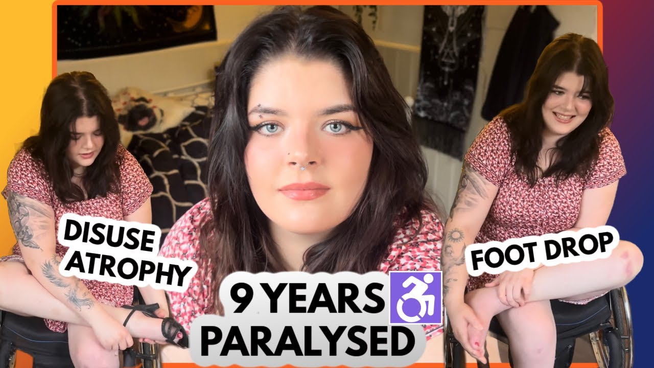 What 9 years of paralysis looks like! disuse atrophy, foot drop, decreased blood flow, complications