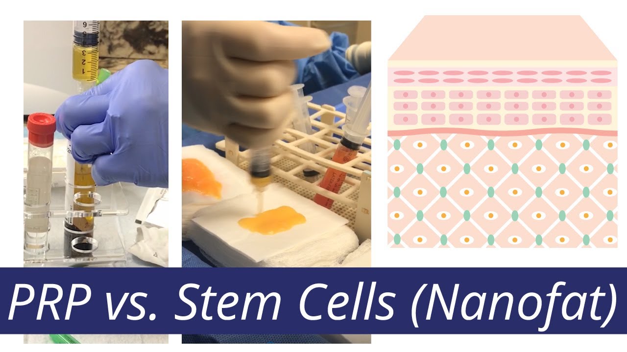 #PRP vs. #StemCells [Difference in what Nanofat & PRP can do]