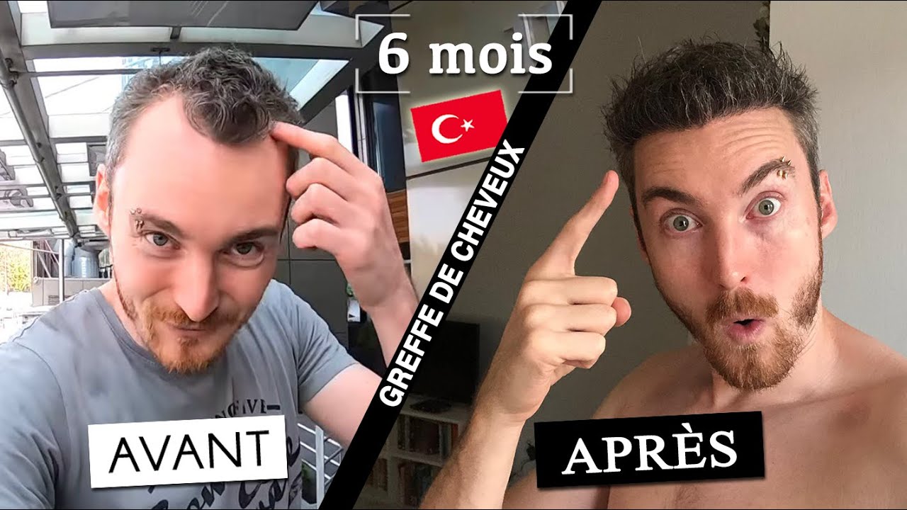[Greffe de cheveux AVANT / APRÈS] Mes résultats après 6 mois ! 🇹🇷