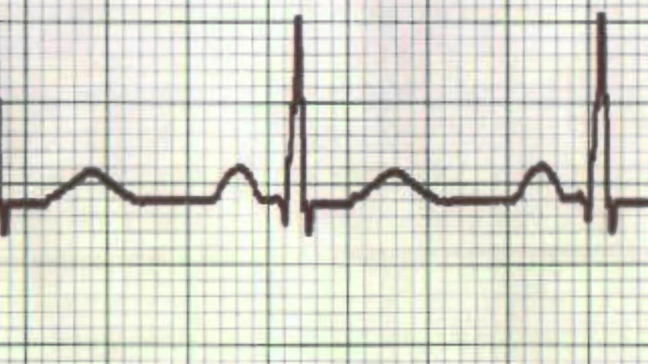 ECG: The Rhythm Strip
