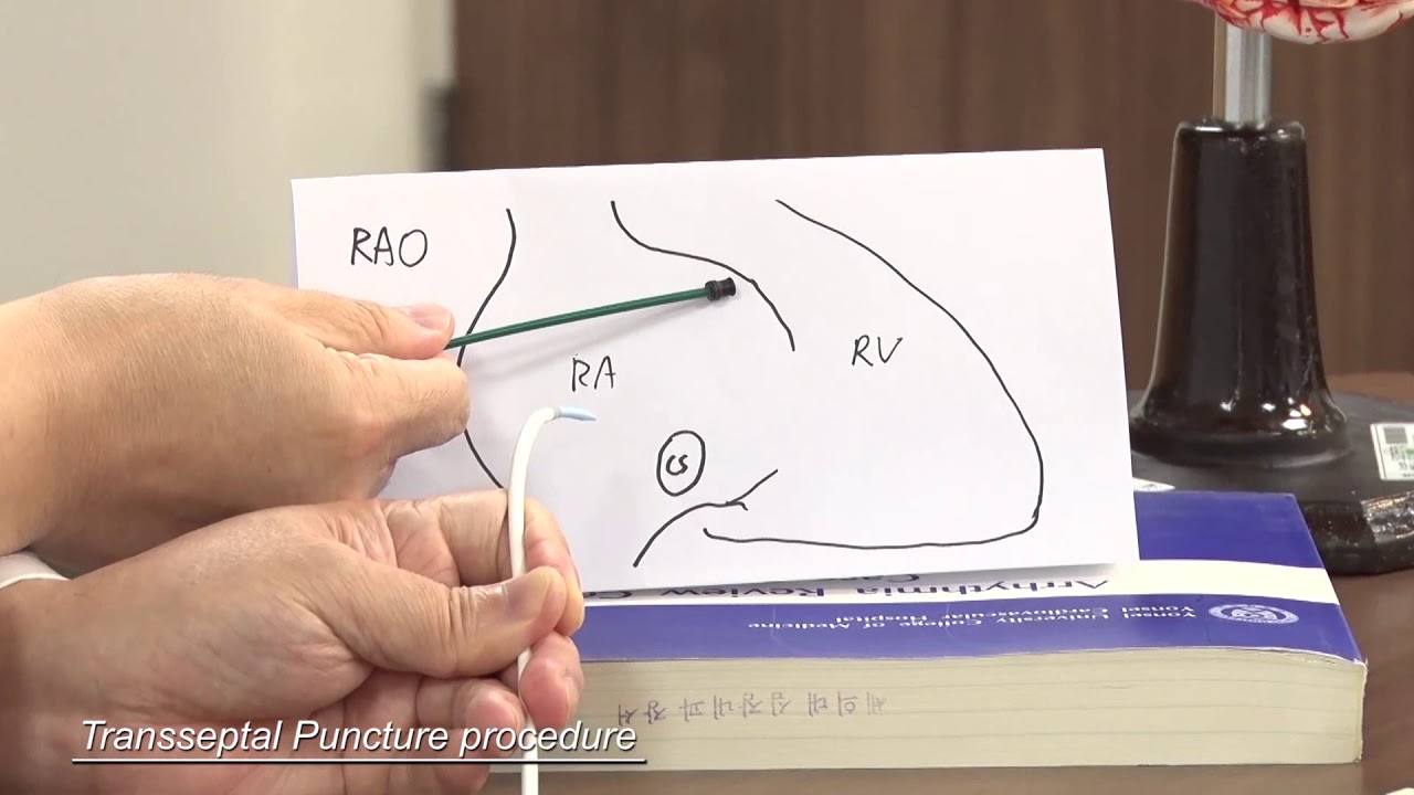 AF Ablation/ #3  Trans septal puncture