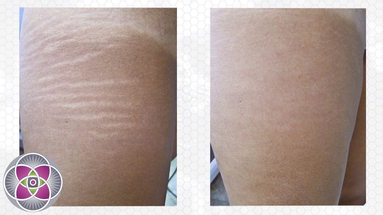 Laser Stretch Marks Removal Treatment