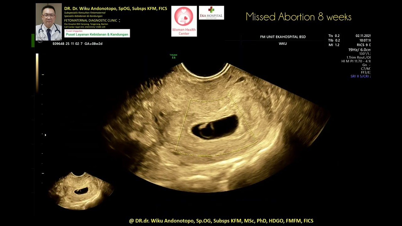 Missed abortion 8 weeks