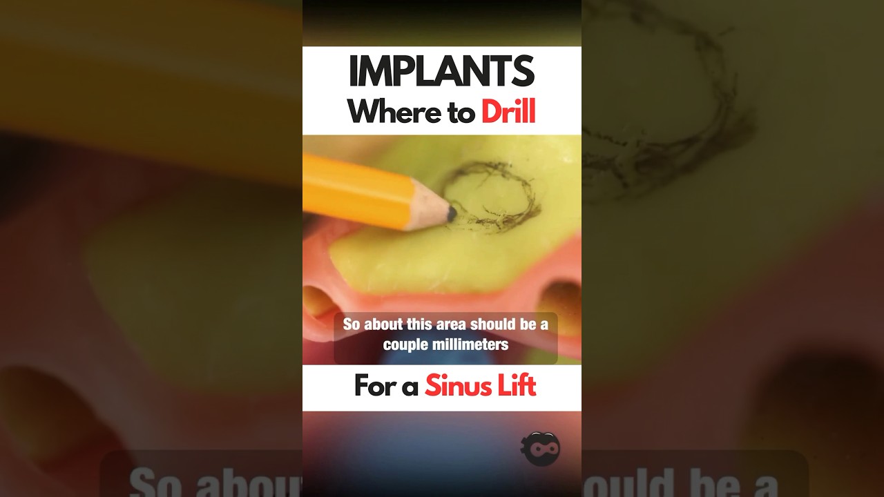 Sinus Lift Prep outline - where to drill? #implantplacement #implants #oralsurgery