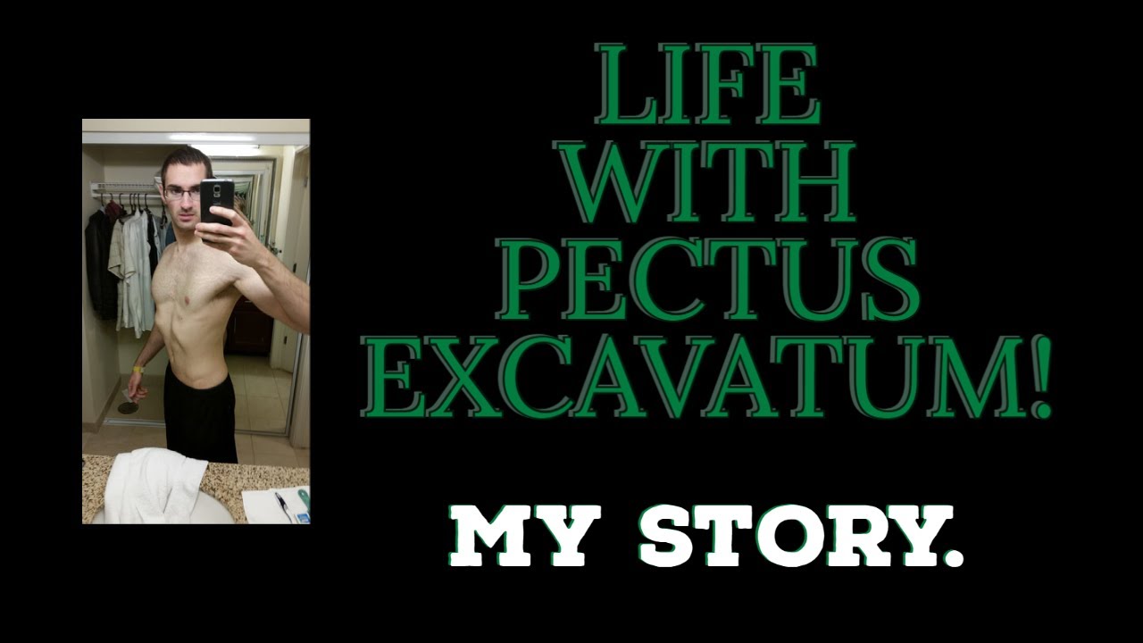 Life Growing Up With Pectus Excavatum! (TELL ALL!)
