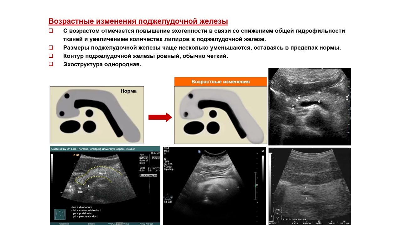 Ультразвуковая диагностика. Доктор Иогансен. Выпуск 45. Диффузные изменения поджелудочной железы.