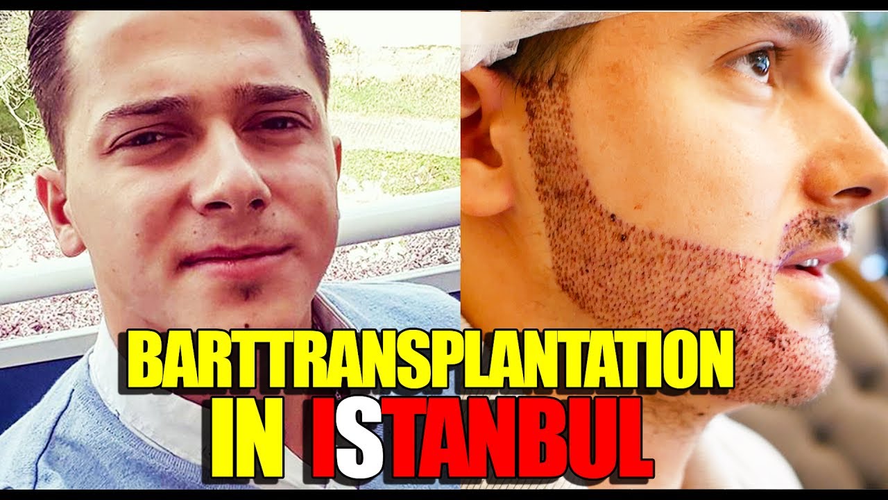 BARTTRANSPLANTATION IN ISTANBUL | VLOG | (+ENGLISH SUBTITLES)