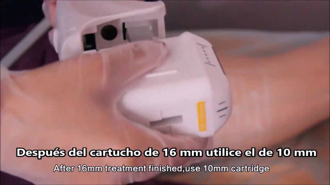 HIFU Tratamiento piernas