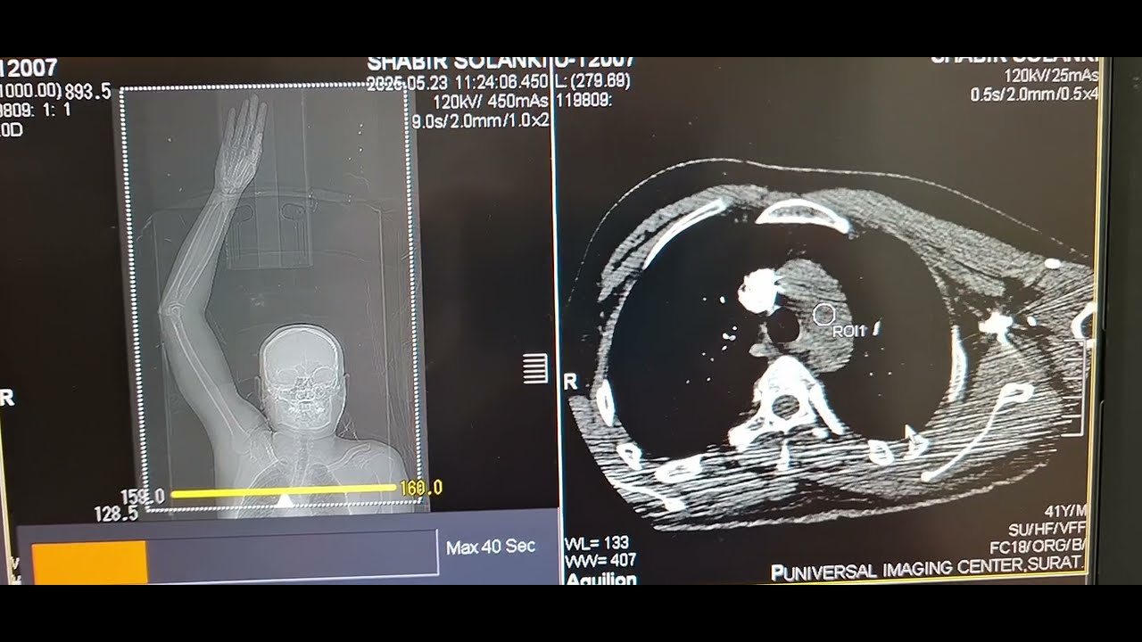 CT Upper Limb Angiography.