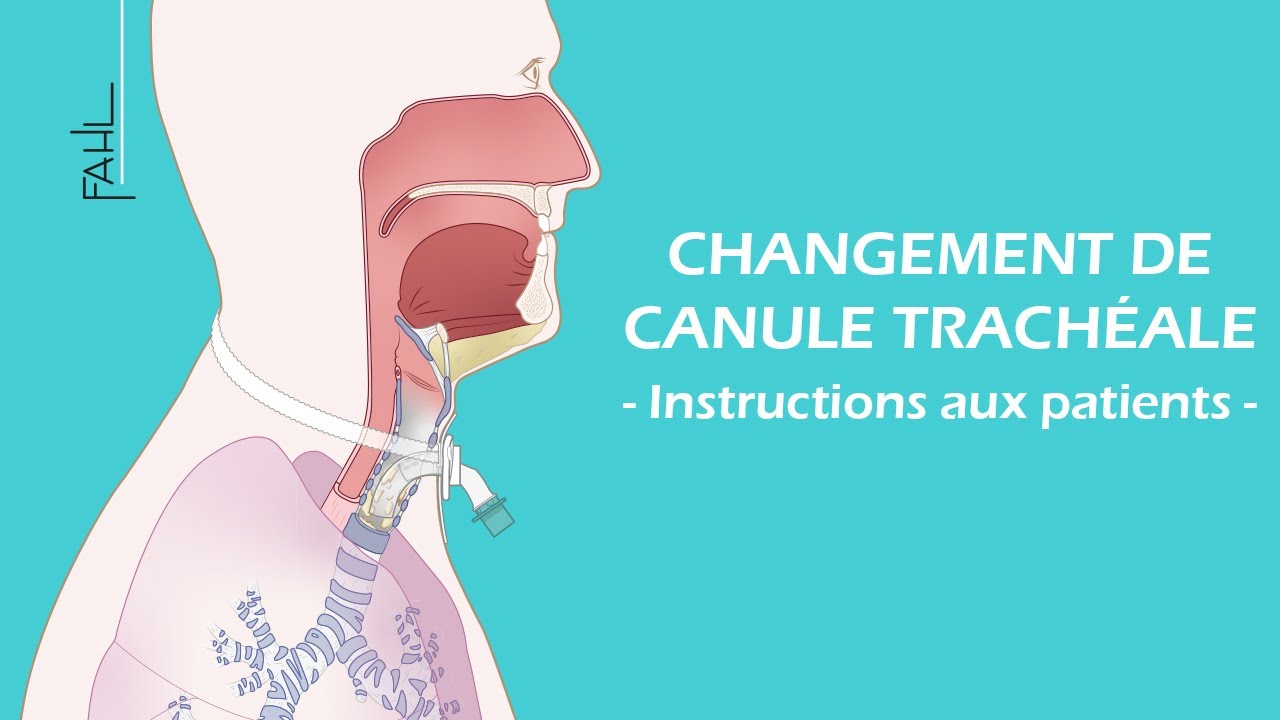 Changement de canule trachéale pour les patients | Animation | Fahl Medizintechnik-Vertrieb GmbH