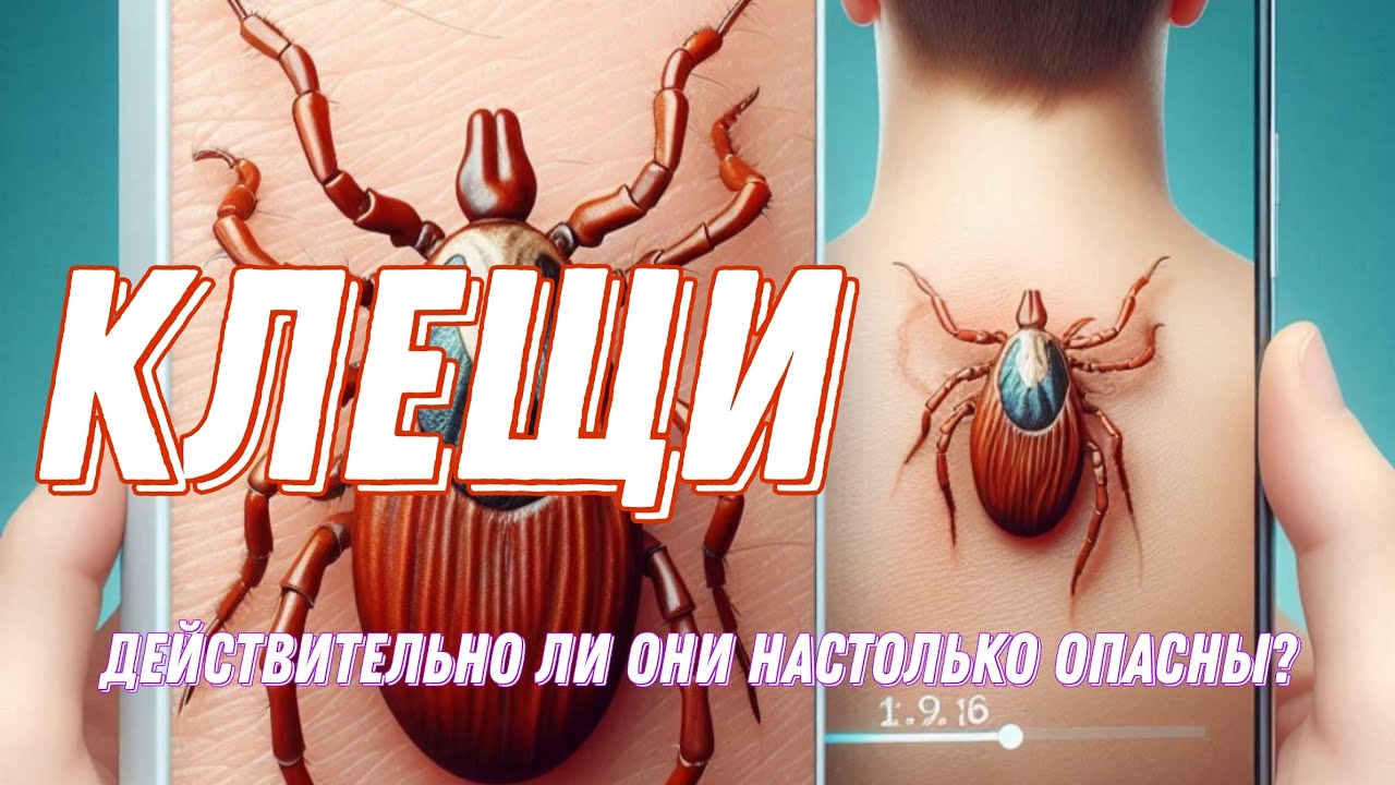 Клещи смертельная угроза? Как без вреда для себя удалить его и что делать, если укусил? Советы врача