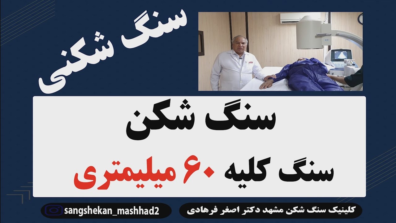 سنگ شکن کلیه : سنگ شکن کلیه با سنگ کلیه 60 میلیمتری ESWL