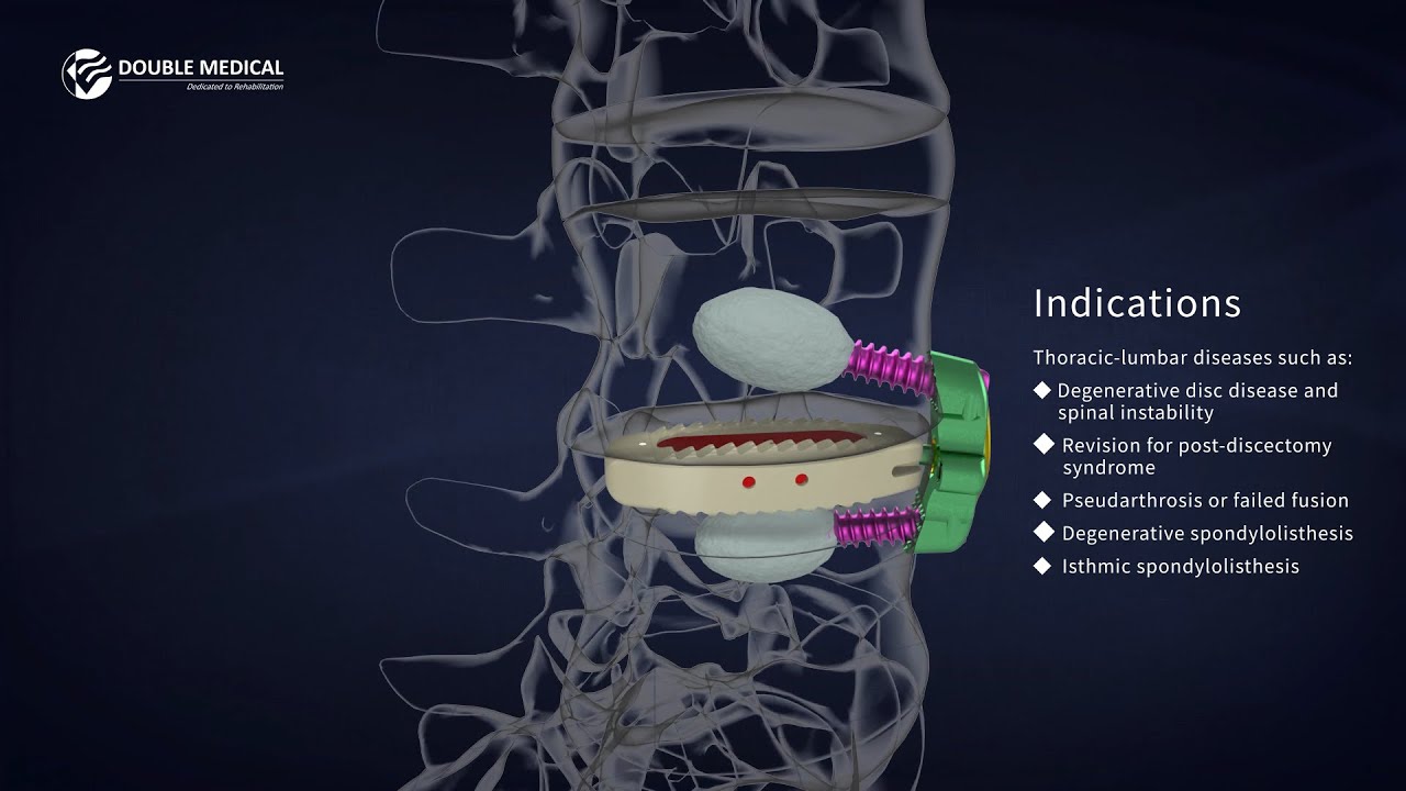 OLIF Surgery Procedure Video with Double Medical Oblique Lateral Intervertebral Fusion Cage System