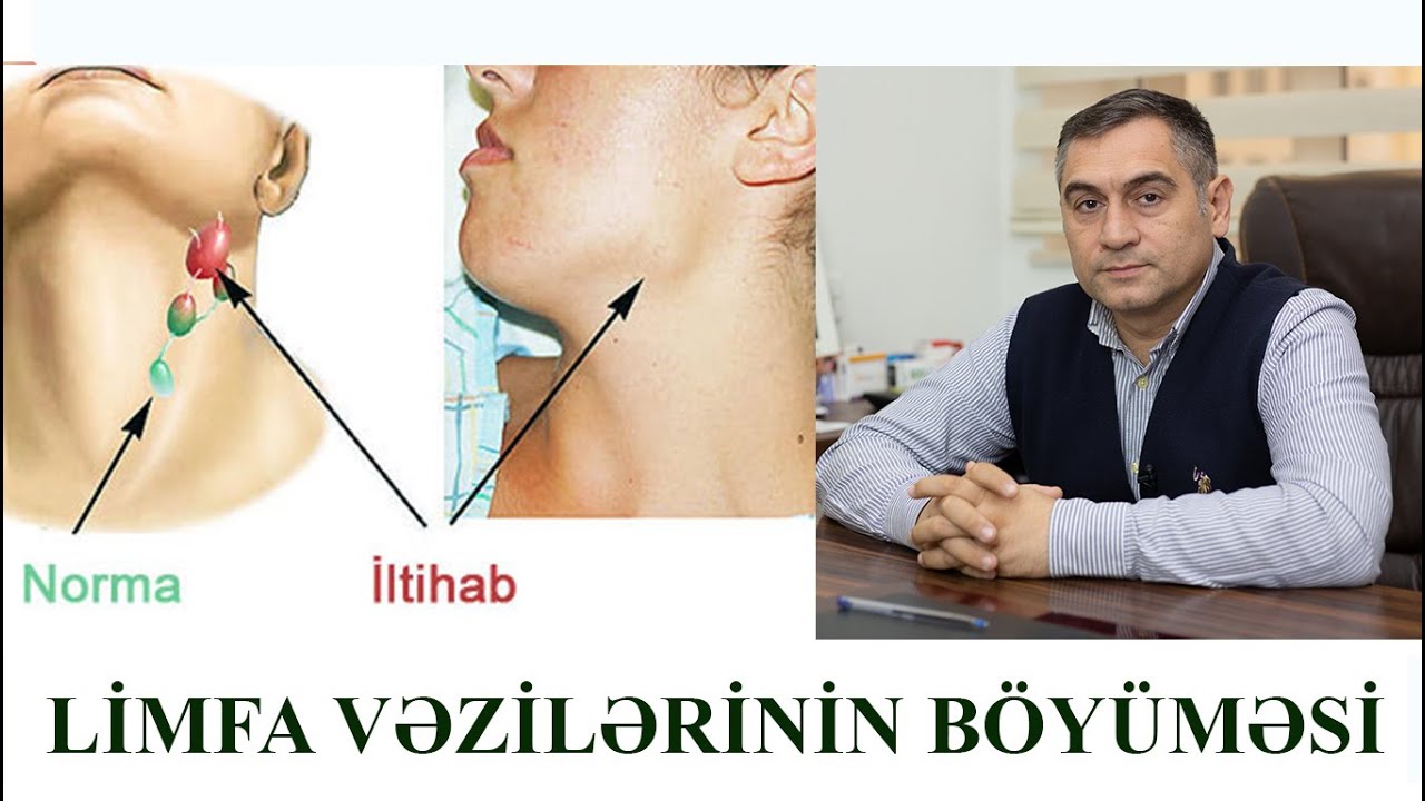 Limfa Vəzilərinin Böyüməsi  MÜTLƏQ BAXIN