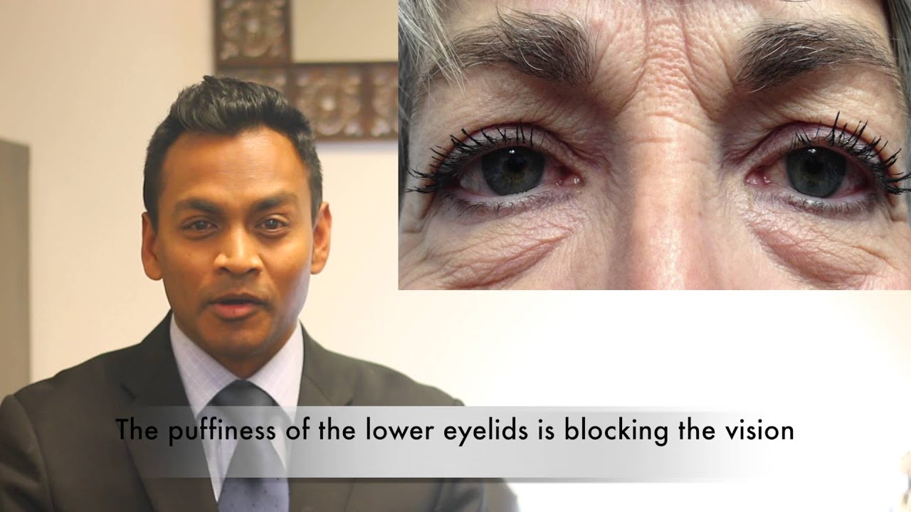 When does Insurance cover Cosmetic Eyelid Surgery or Blepharoplasty?