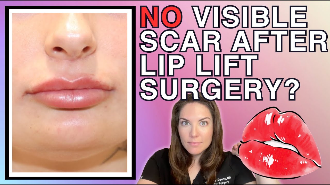 The Invisible Lip Lift Scar Trick They Don't Want You to Know