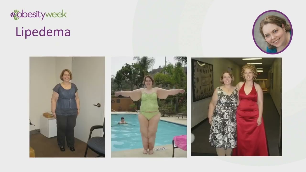 Patient Perspectives on Lipedema