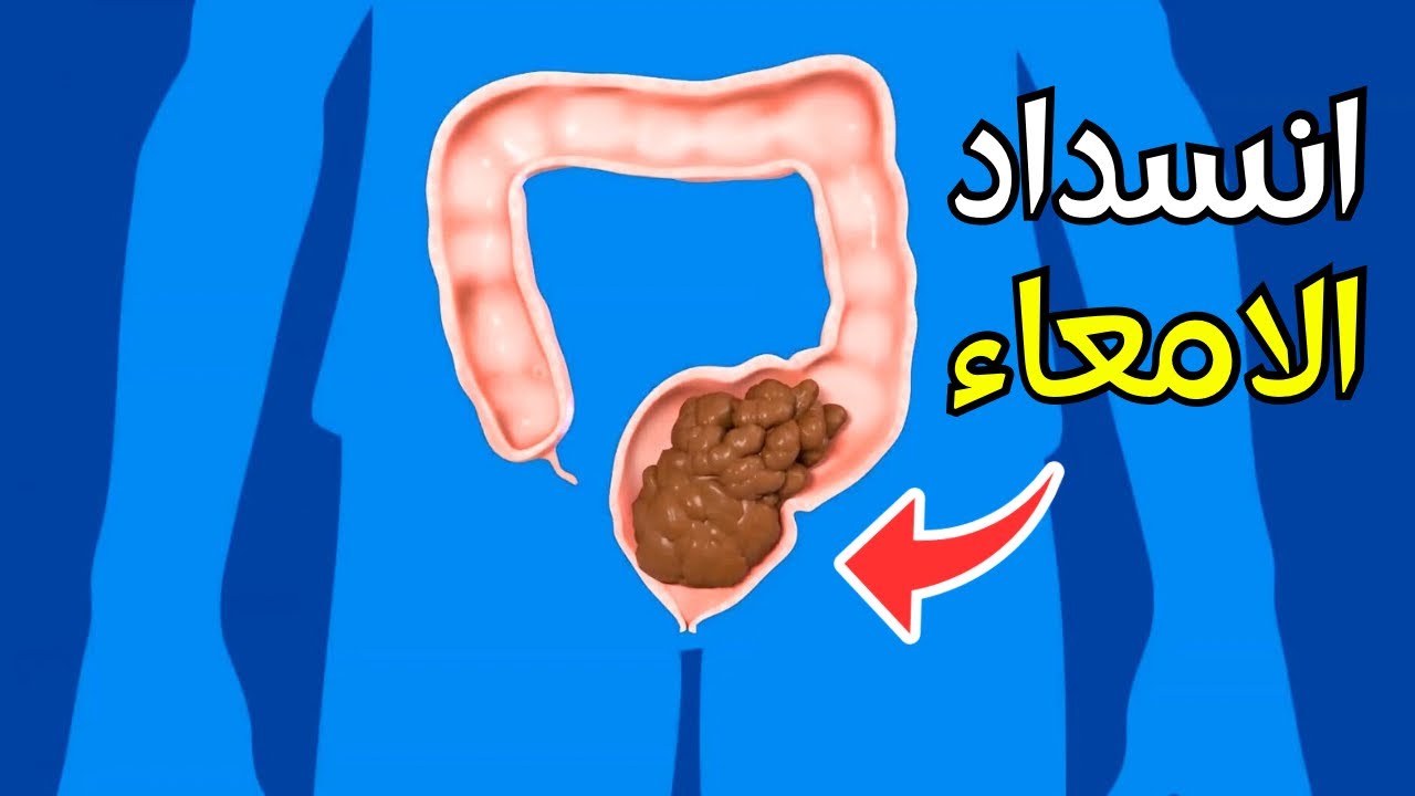 شاهد ماهو انسداد الامعاء | وكيف يتم تشخيصة وعلاجة _  Understanding Bowel Obstruction