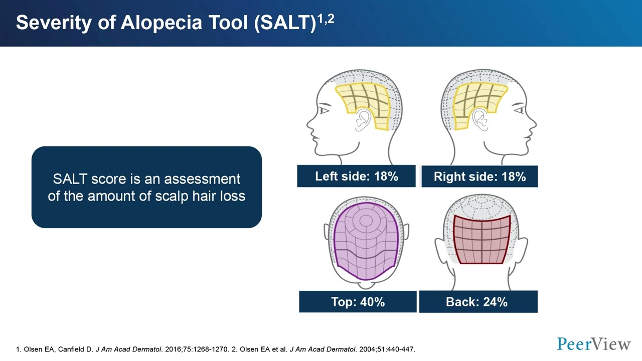 Elevating Alopecia Areata Management