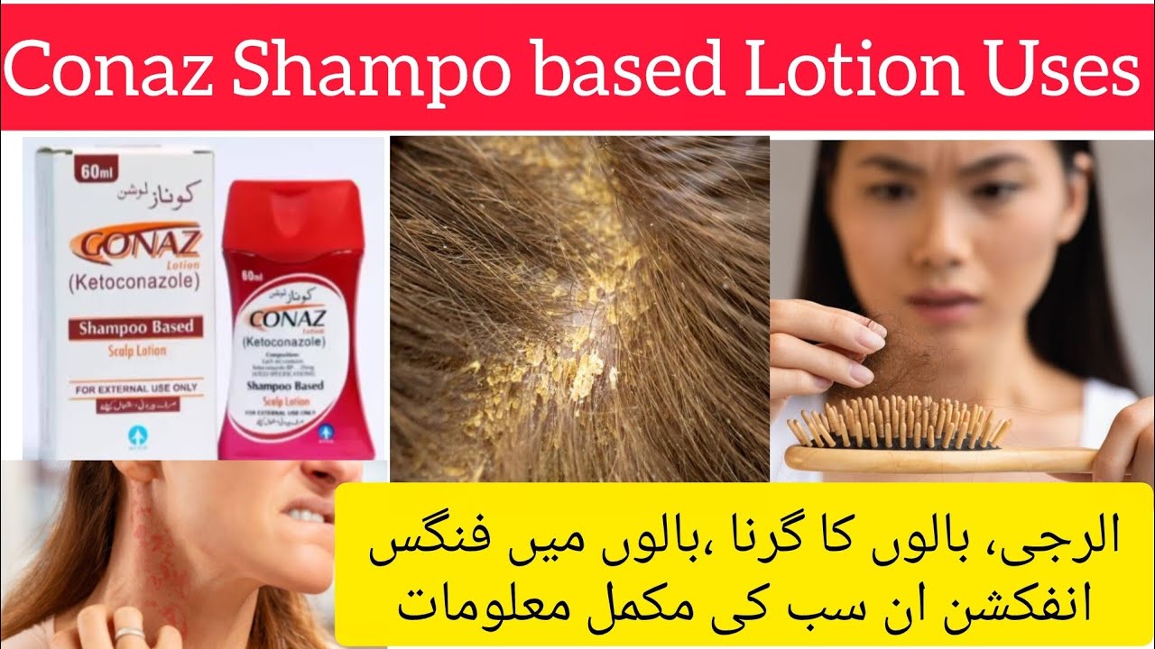 Conaz lotion uses | Conaz Shampo uses |Hair Fall | Allergy | Fungal infections in Hairs | Conaz uses