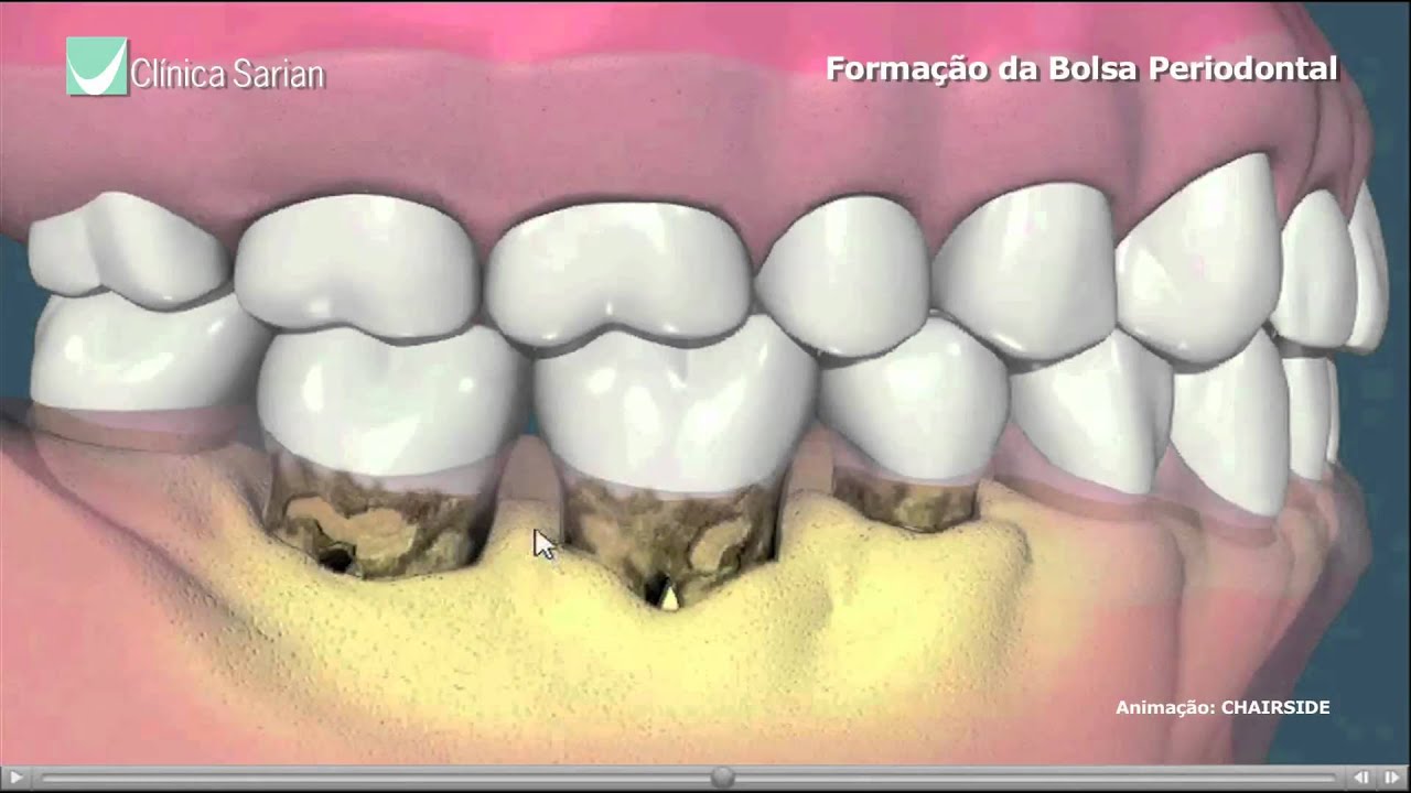 Formação da Bolsa Periodontal