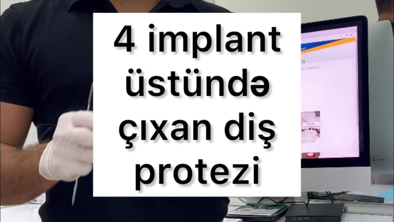 Alt çənədə protez saxlanılması çətinləşdikdə çözüm nədir? Dörd implant üstündə çıxan diş protezi.