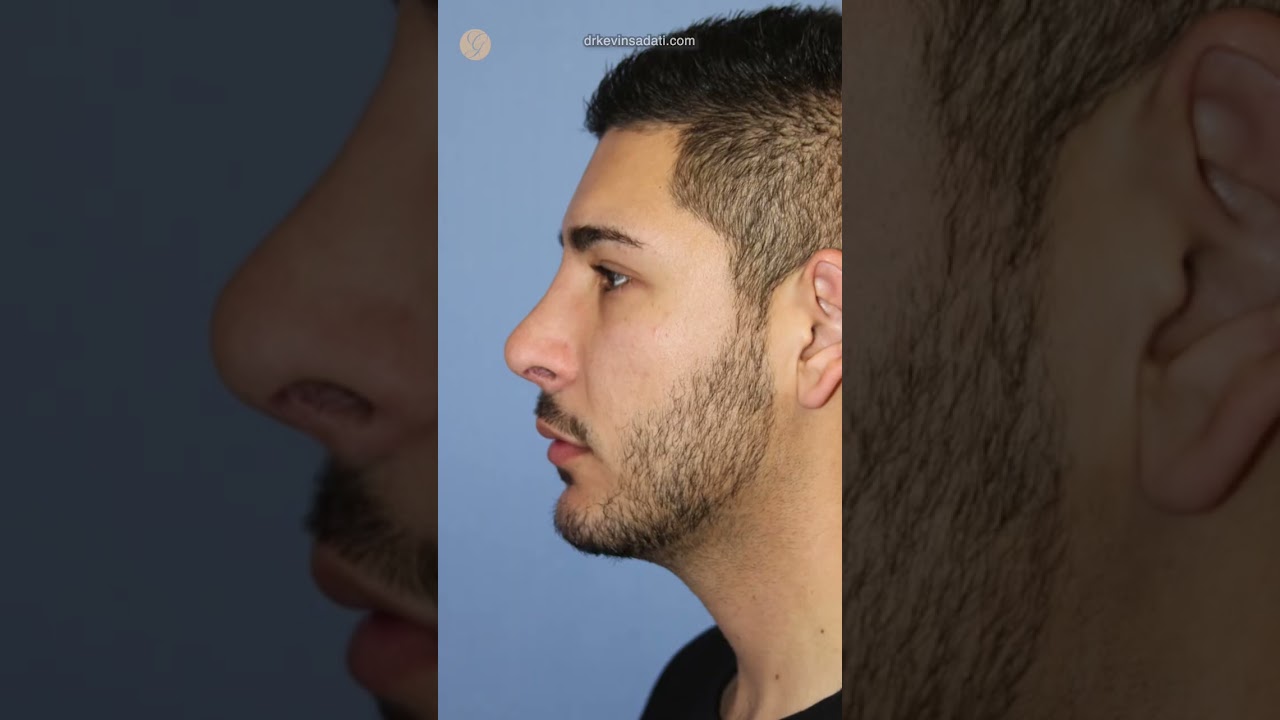 Revision Rhinoplasty & Chin Augmentation by Dr. Kevin Sadati #plasticsurgery #rhinoplasty #surgery