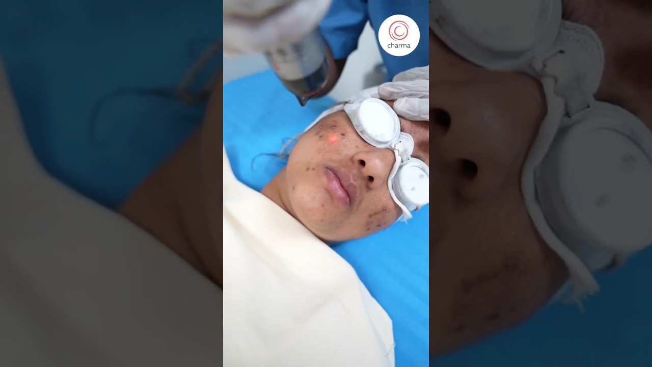 How Laser Toning Treatment Can Transform Your Acne Spots? - Charma Clinic