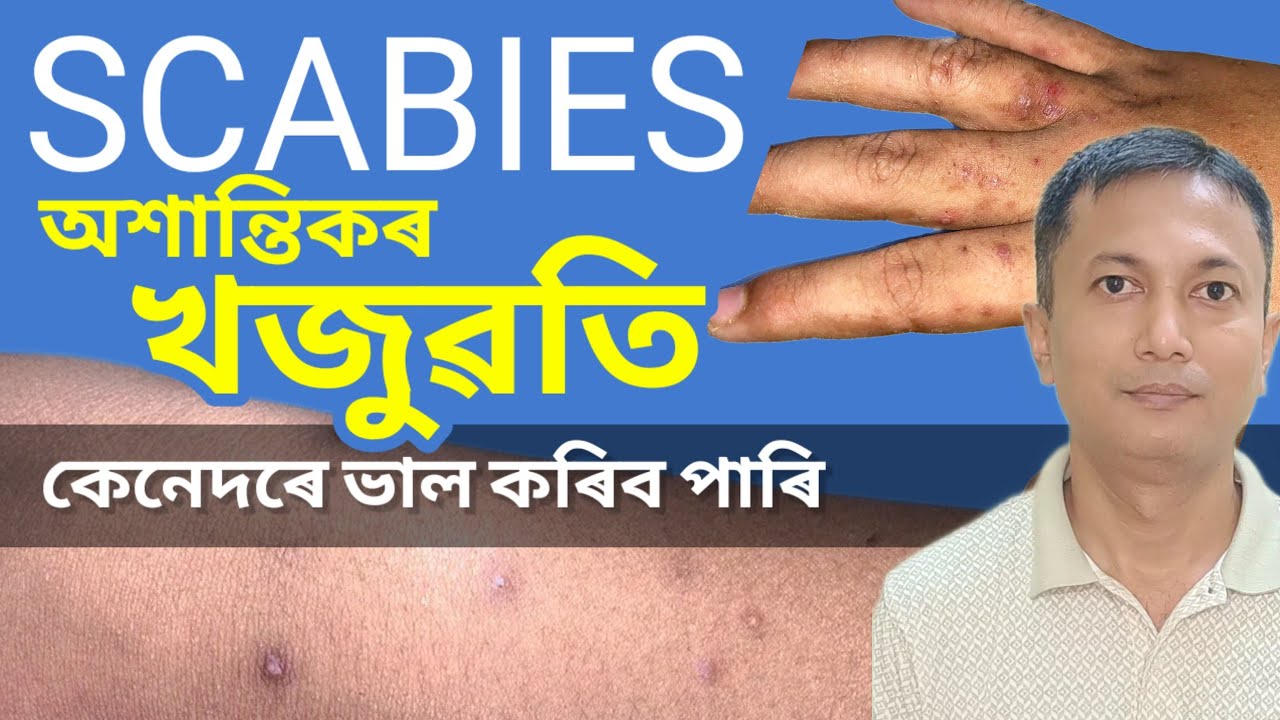 গোটেই গাত খজুৱতি? এই ভুল কৰিলে কেতিয়াও ভাল নহ’ব । Scabies 