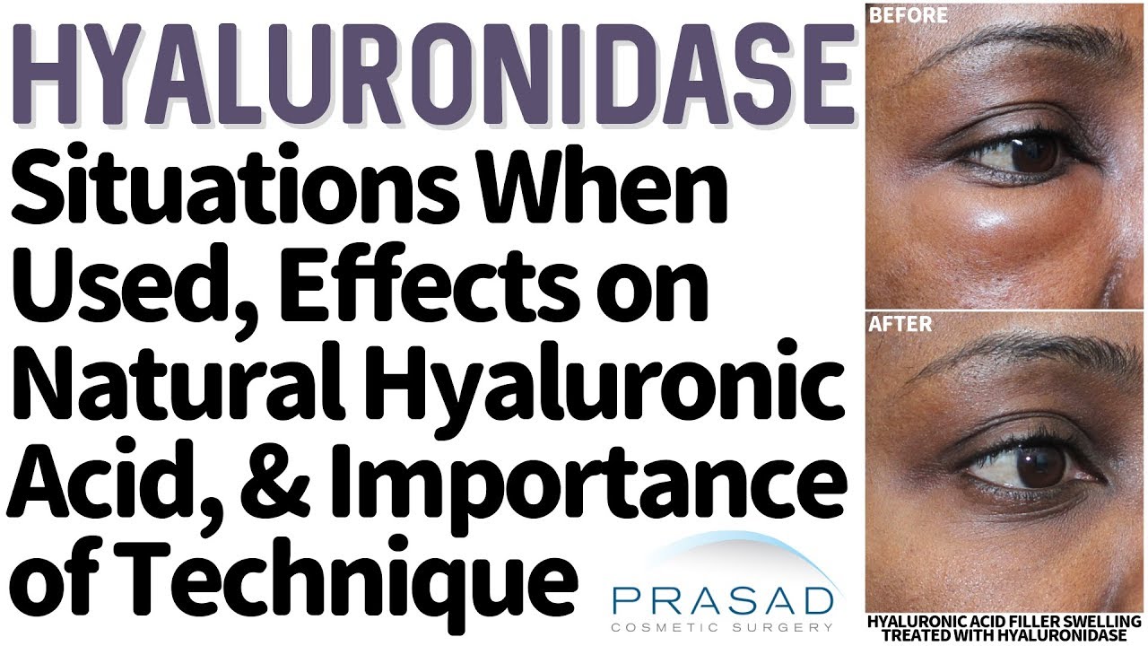 Effects of Hyaluronidase on Cosmetic Fillers, and Natural Hyaluronic Acid