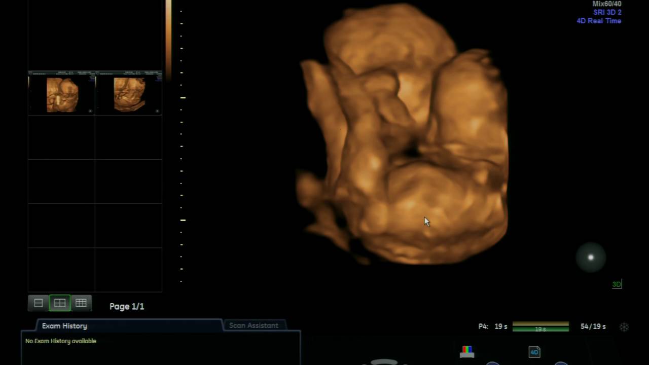 utrasson 4D do meu segundo bebe