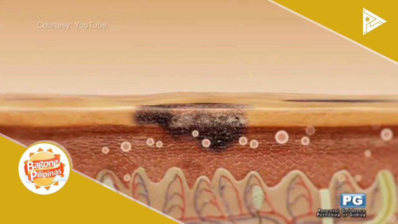DERMAESTHETIC | Melasma treatment using Nd:YAG laser