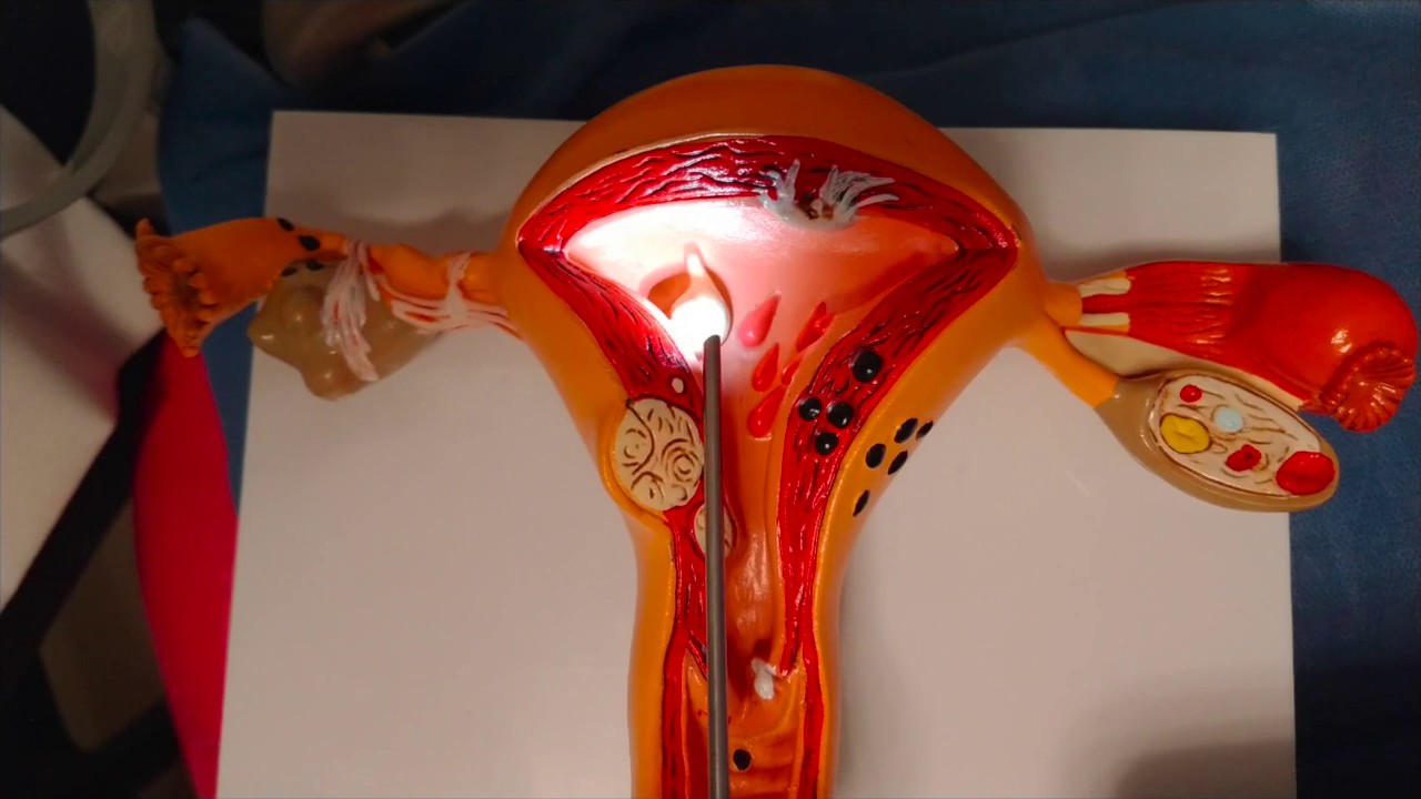 Qué es una histeroscopia? como se hace? aquí una breve explicación