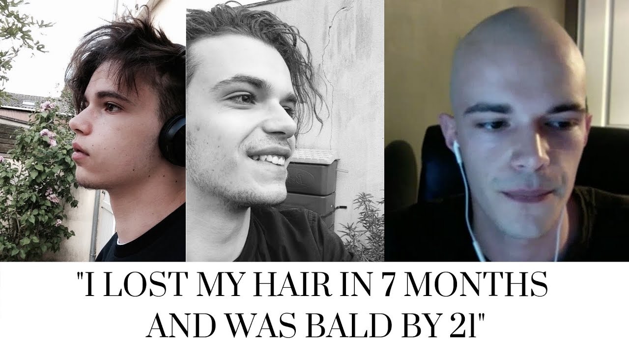 GOING BALD YOUNG *Bald at 21* The Bald Cafe Podcast Ep 6