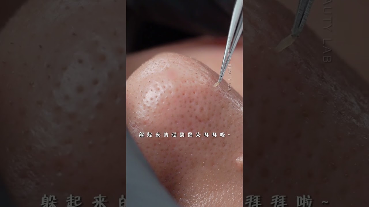 #Immersive Skin Care #Blackhead Removal #Strawberry Nose #Blackhead #Deep Pore Cleansing