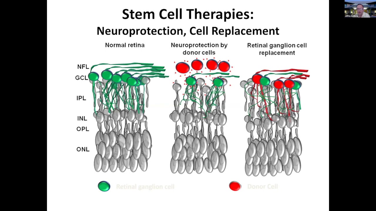 Regeneration and stem cell transplantation as treatment for optic neuropathies