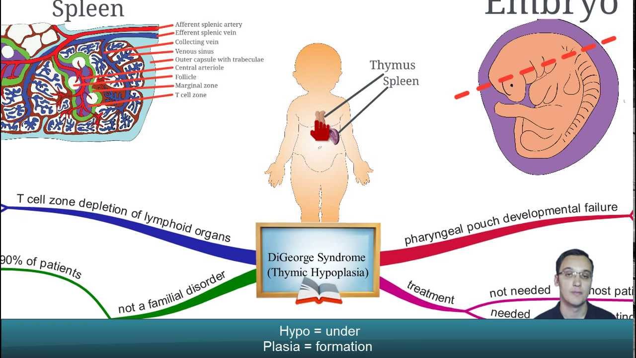 Digeorge syndrome