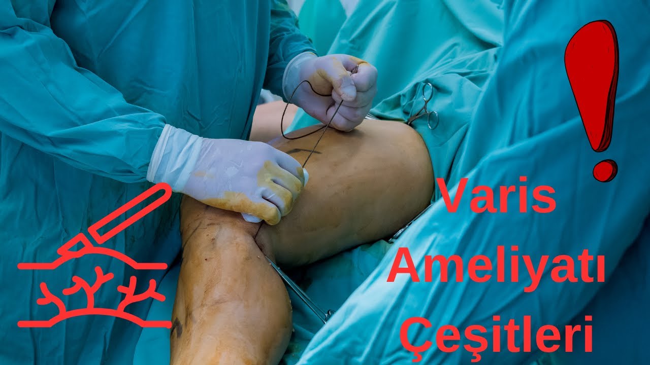 Varis Ameliyatı Çeşitleri | Klasik Cerrahi | Açık Teknik | MOCA | Lazer | Glue | Dr. Aybanu Gökçen